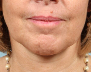 Face and Neck Lift Case 11806 After Photo Face and Neck Lift