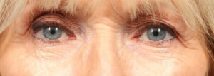 Blepharoplasty