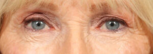 Blepharoplasty