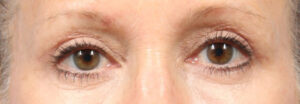 Blepharoplasty