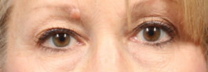 Blepharoplasty