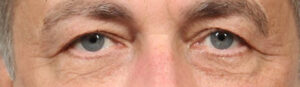 Blepharoplasty