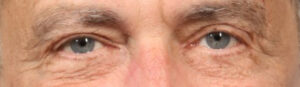Blepharoplasty