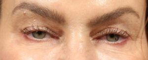 Blepharoplasty