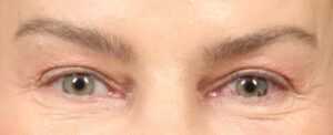 Blepharoplasty