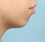 Cheek and Chin Augmentation