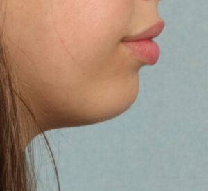 Cheek and Chin Augmentation