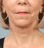 Face and Neck Lift
