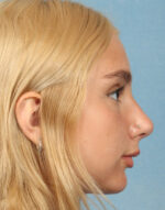 Rhinoplasty for Teens