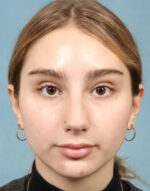 Rhinoplasty for Teens