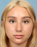 Rhinoplasty for Teens