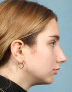 Rhinoplasty for Teens