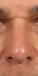 Rhinoplasty for Men