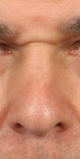 Rhinoplasty for Men