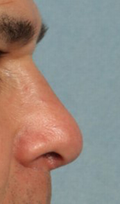 Rhinoplasty for Men