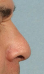 Rhinoplasty for Men