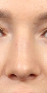 Rhinoplasty for Women