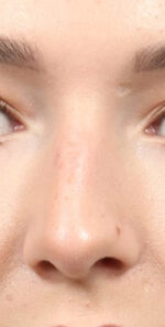 Rhinoplasty for Women