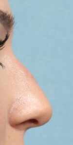 Rhinoplasty for Women