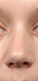 Rhinoplasty for Teens