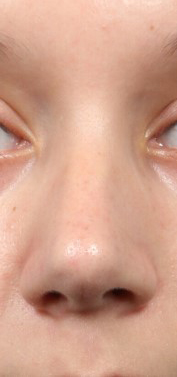 Rhinoplasty for Teens