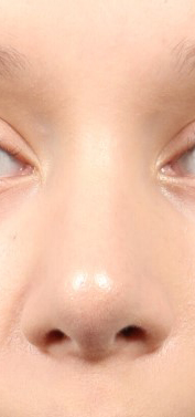 Rhinoplasty for Teens