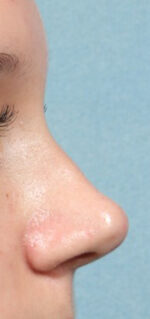 Rhinoplasty for Teens