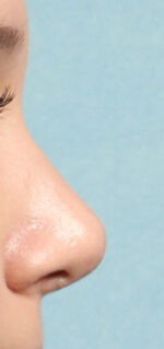 Rhinoplasty for Teens
