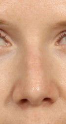 Rhinoplasty for Women