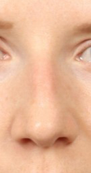 Rhinoplasty for Women