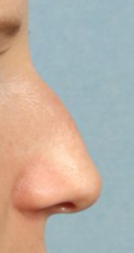 Rhinoplasty for Women