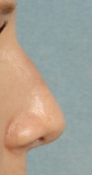 Rhinoplasty for Women