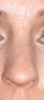 Rhinoplasty for Women