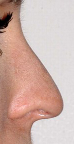 Rhinoplasty for Women