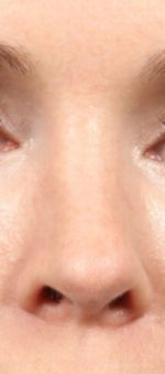 Rhinoplasty for Women