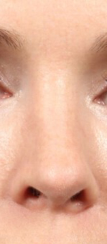Rhinoplasty for Women Case 11820 After Photo Rhinoplasty for Women