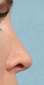 Rhinoplasty for Women