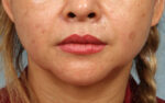 Face and Neck Lift