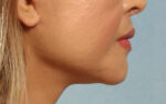 Face and Neck Lift