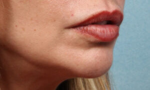 Cheek and Chin Augmentation