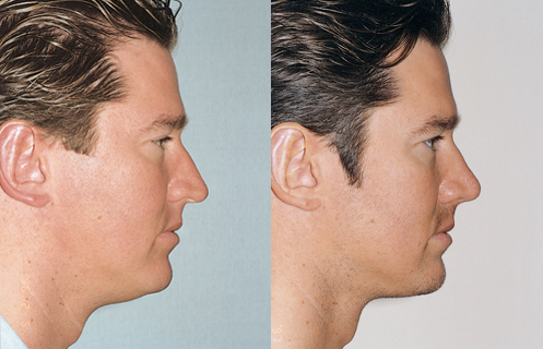 Rhinoplasty for Men Before & After Results