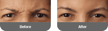 injectable and filler before and after photos